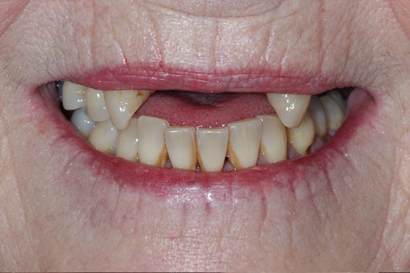 Jaw Registration For 
      Partial Dentures Perrinton MI 48871